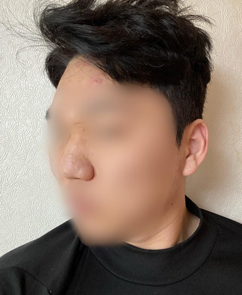 Хамрын нуруу, үзүүр, том хамар засах, хамарны ясны жижигсгэл