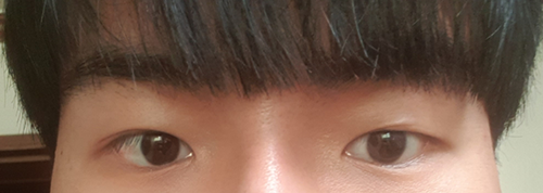 Хэсэгчилсэн зүслэгтэй зовхи заслын дахин хагалгаа