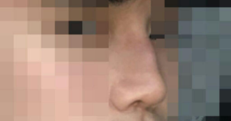 Хамрын нуруу, хамрын үзүүр, бөхөн, хамрын ясны жижигсгэл