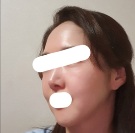 Нүүр өргөх дахин хагалгаа хийлгэсний дараа хуучин зургаа хараад баяртай байна ^^