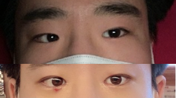 Давхар зовхи (булагдсан), урд зүсэлт