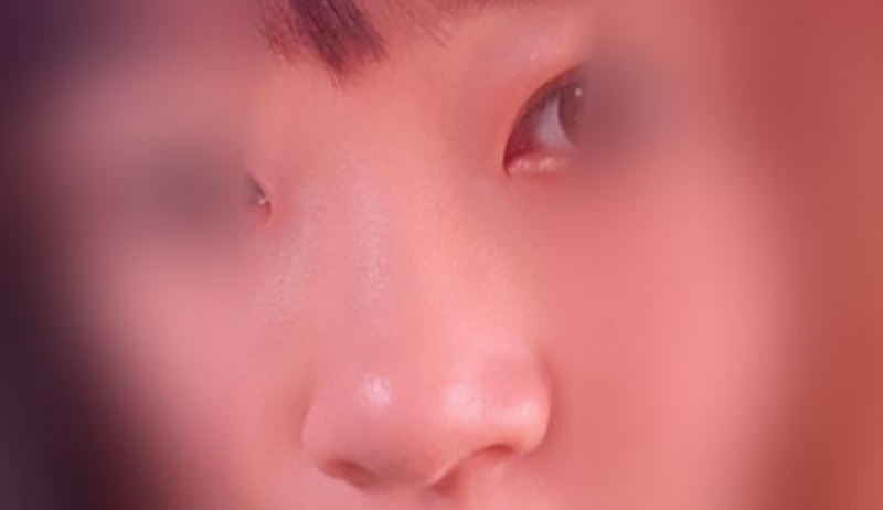 Би Жейжүн гоо сайхны мэс заслын эмнэлэгт хамрын филлер хийлгэсэн : )