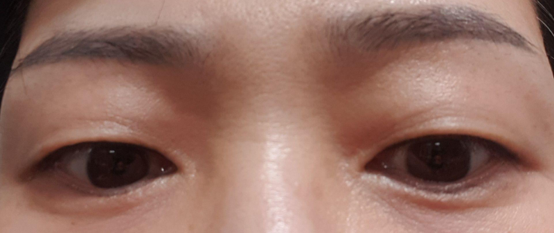 Давхар зовхи (зүсэлт)