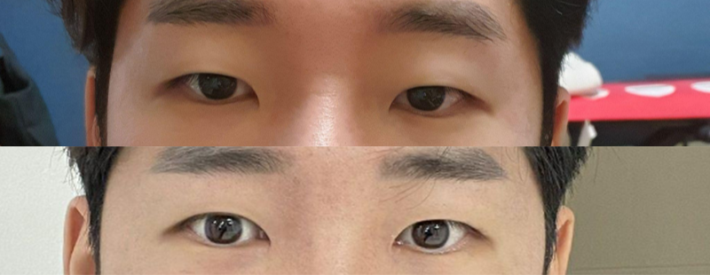 Нүдний хэлбэр засах (хэсэгчилсэн зүслэг), урд талын хэсгийг нээх