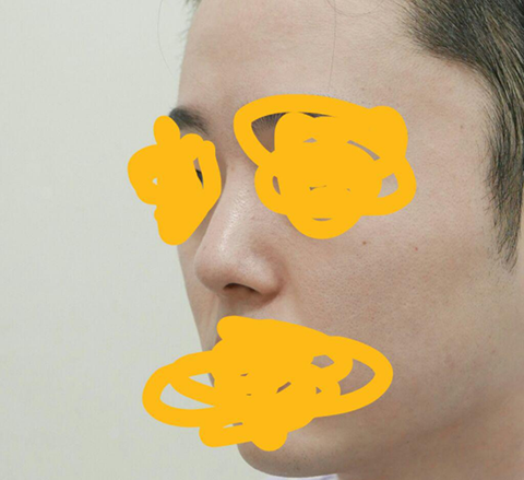 Хэдэн жилийн өмнө хийлгэсэн хамар таалагдаагүй тул Жэйжүүн эмнэлэгт хамрын дахин хагалгаа хийлгэсэн.