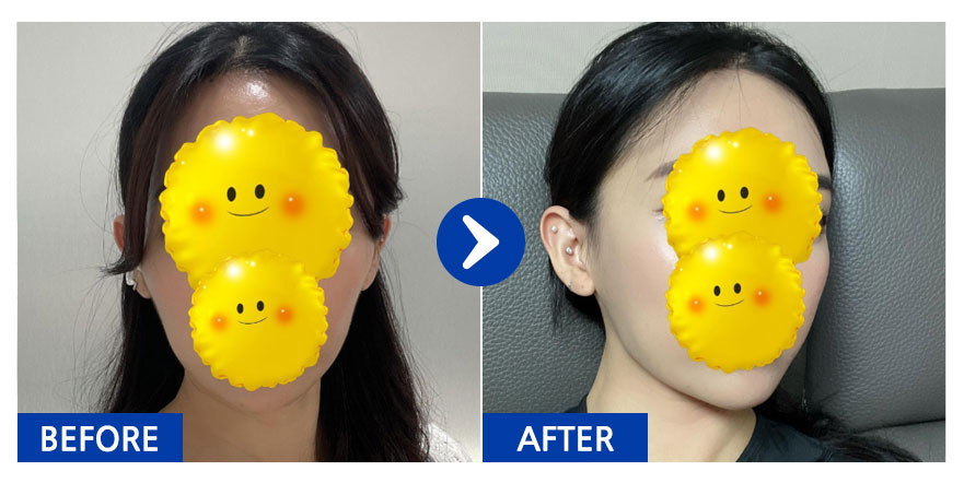 [바비톡] 안면윤곽 / 2개월차/ 닉네임: 치이이이킨