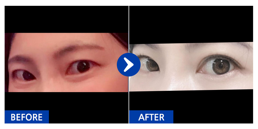 [바비톡] 쌍꺼풀 / 3개월차 / 닉네임 : 하나사마