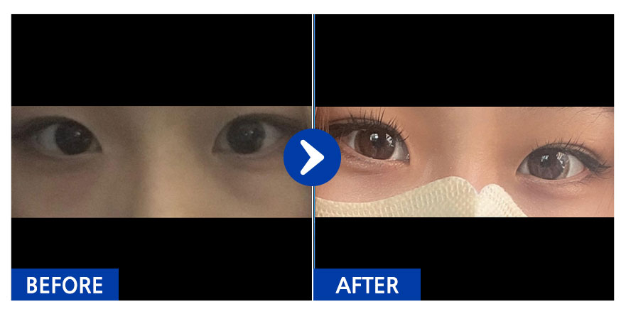 [바비톡] 눈밑, 쌍꺼풀(매몰) / 2개월차 / 닉네임 : 언이어니언디