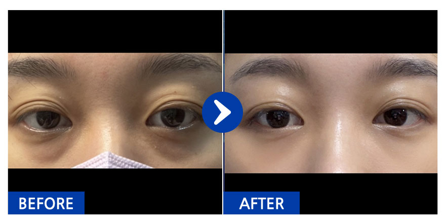 [강남언니] 눈밑지방재배치 / 1개월차/ 닉네임:이웃집요미