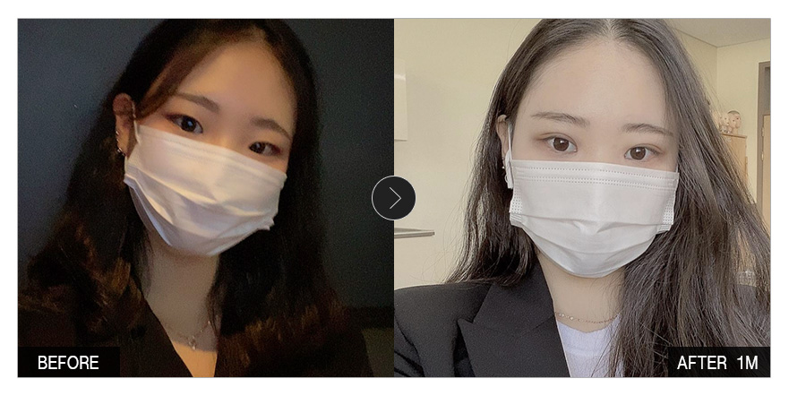 [강남언니 후기]  눈성형 한 달차 / 닉네임 : 내눈이니눈