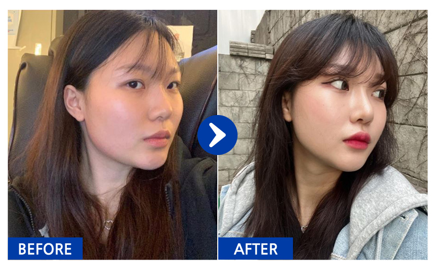 [바비톡] 코성형 / 10개월차 / 닉네임 : 설윤2