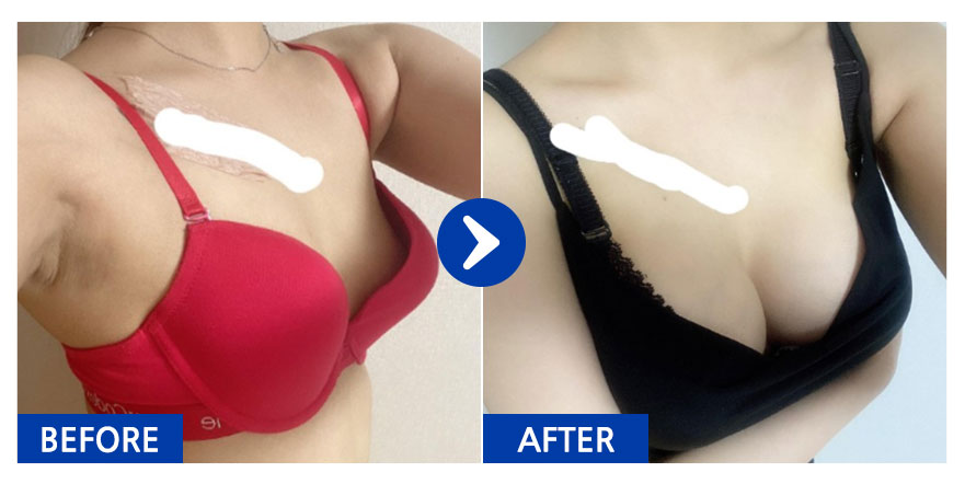 [바비톡] 가슴성형 / 8개월차/ 닉네임:멜룡