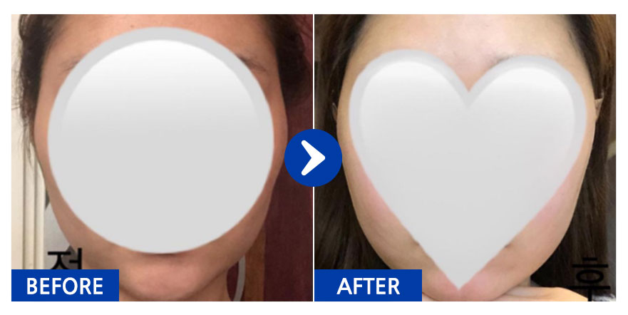 [강남언니] 안면윤곽 / 1개월차 / 닉네임: daldal2