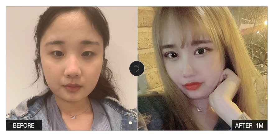 [바비톡 후기]  눈성형, 윤곽성형 한 달차 / 닉네임 : 지와링