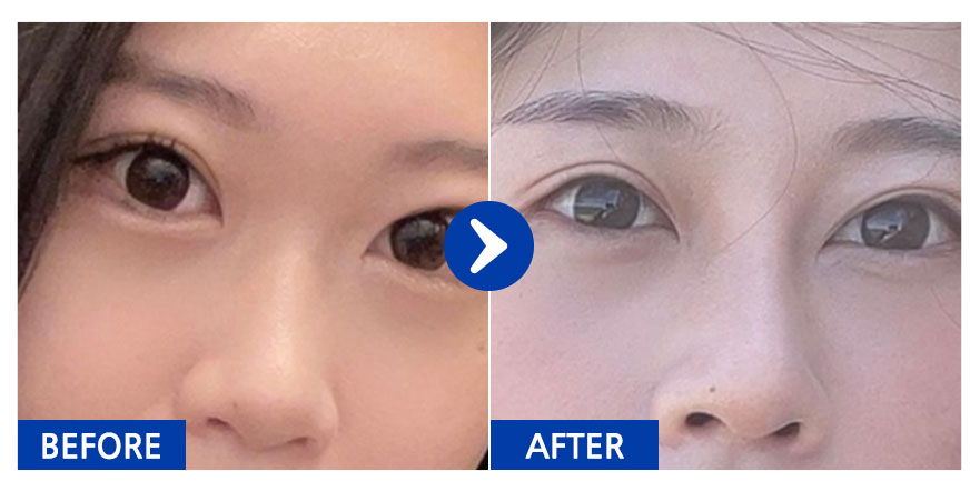 [강남언니] 코성형 / 2개월차 / 닉네임:옹츄