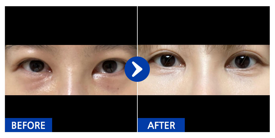 [강남언니] 눈밑지방재배치 / 1개월차 / 닉네임:anjjjjjjj