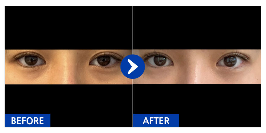 [강남언니] 눈밑지방재배치 / 1개월차/ 닉네임: OooO와