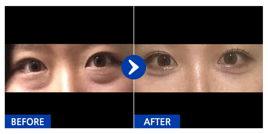 [강남언니] 눈밑재배치 / 1개월차/ 닉네임: 쓰잉