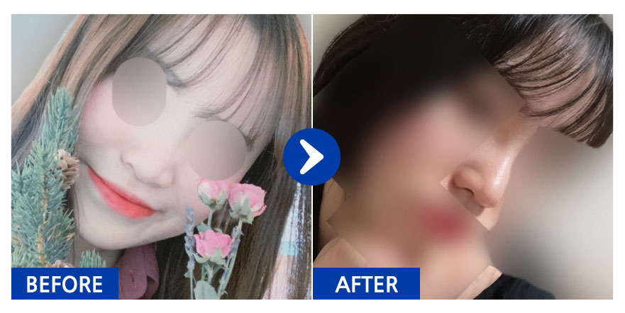 [강남언니] 코성형 1개월차 / 닉네임 : v1nnn