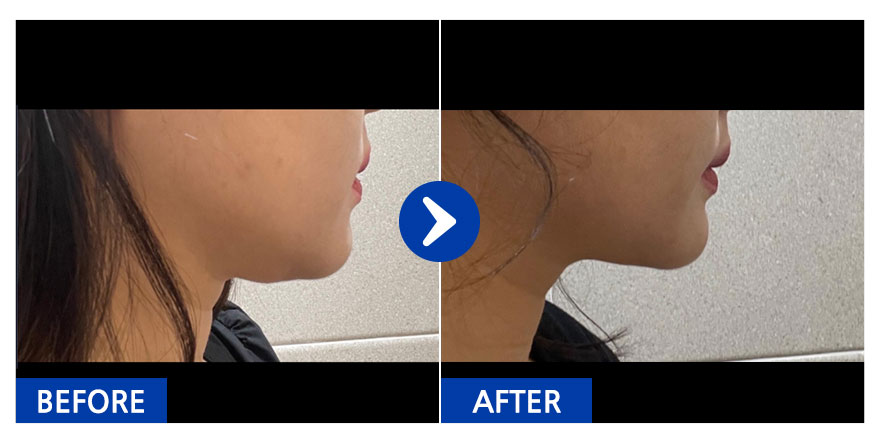 [강남언니] 얼굴지방흡입 1개월차 / 닉네임 : mj_park