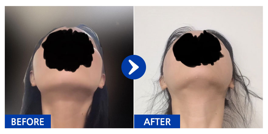 [강남언니] 광대 1개월차 / 닉네임 : 하하하하하하하마