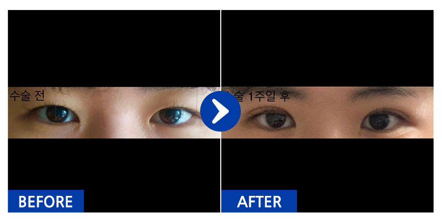 [강남언니] 쌍꺼풀(매몰) 1주차 / 닉네임 : 두두따다