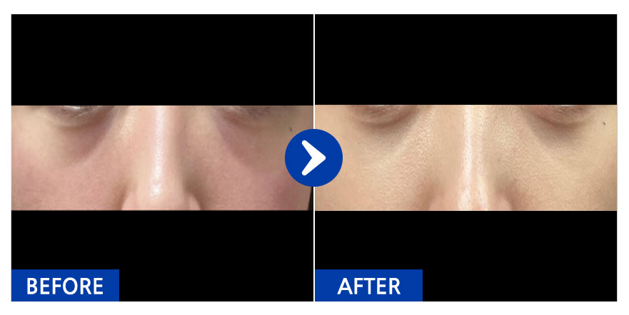 [강남언니] 눈밑지방재배치 / 1개월차 / 닉네임 : 라면김밥떡볶이