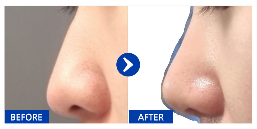 [강남언니] 코 / 1개월차 / 닉네임 : nacola