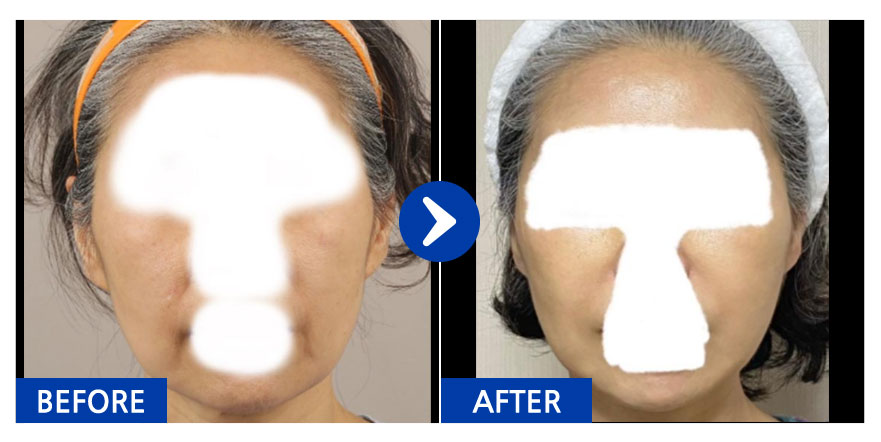 [강남언니] 안면거상술 / 1개월차 / 닉네임 : 안녕언닝닝