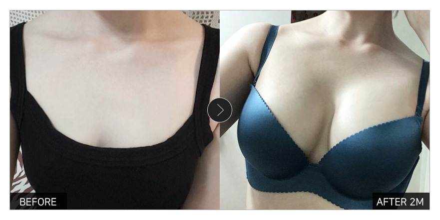 [강남언니 후기] 가슴성형 2개월차 / 닉네임 : 오호호홓