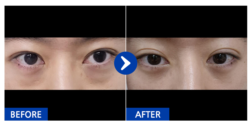 [바비톡] 눈밑지방재배치 / 1개월차 / 닉네임:냥이KdOcl