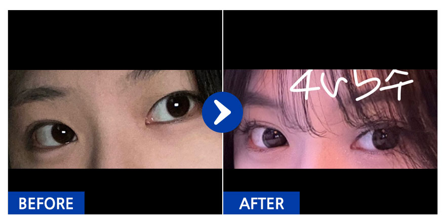 [강남언니] 자연유착 / 1개월차 / 닉네임 : 민트초코버븍티