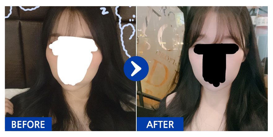 [강남언니] 광대 3개월차 / 닉네임 : 짝눈이잘못했네;