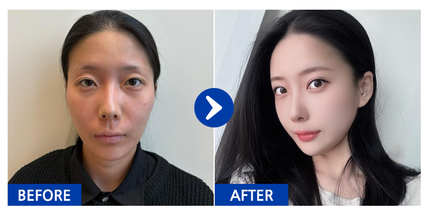 [바비톡] 윤곽3종, 눈매교정, 쌍꺼풀절개, 눈밑지방재배치, 지방이식(볼, 이마) / 1개월차 / 닉네임: 갱쥐Y8tvn