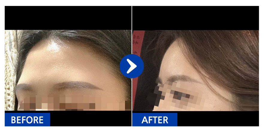 [강남언니] 지방이식 / 2개월차/ 닉네임:영ㅇ0