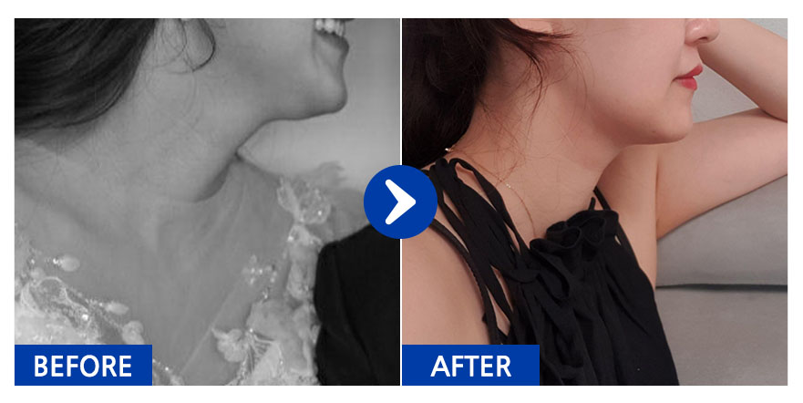 [바비톡] 지방흡입 / 2개월차/ 닉네임:다니쮸쮸