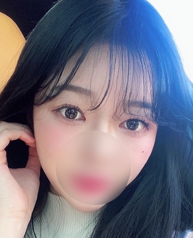 [Нүд] Помодоро - Зүсэлттэй давхар зовхи (Давтан мэс засал)