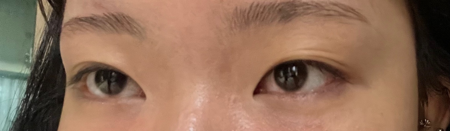 [Нүд] Кокоа - Зүсэлттэй давхар зовхины мэс засал, урд зүсэлт