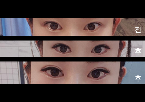 [Нүд] Сөбли9999 - Доод зовхины тайралт, Арьсны тайралт