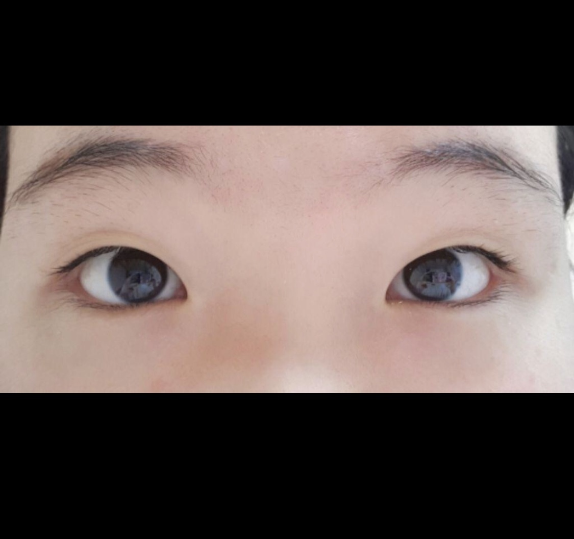 [Нүд] Сөү Юн - Булчингүй оёдол, урд зүсэлт