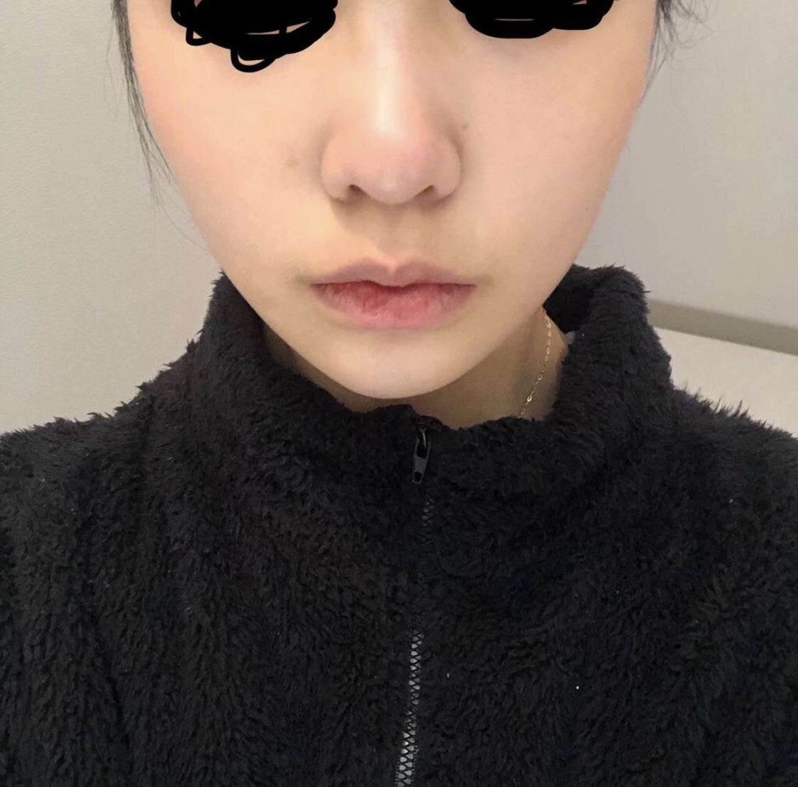 [Хамрын] mm9 - Хамрын жижигсгэлт