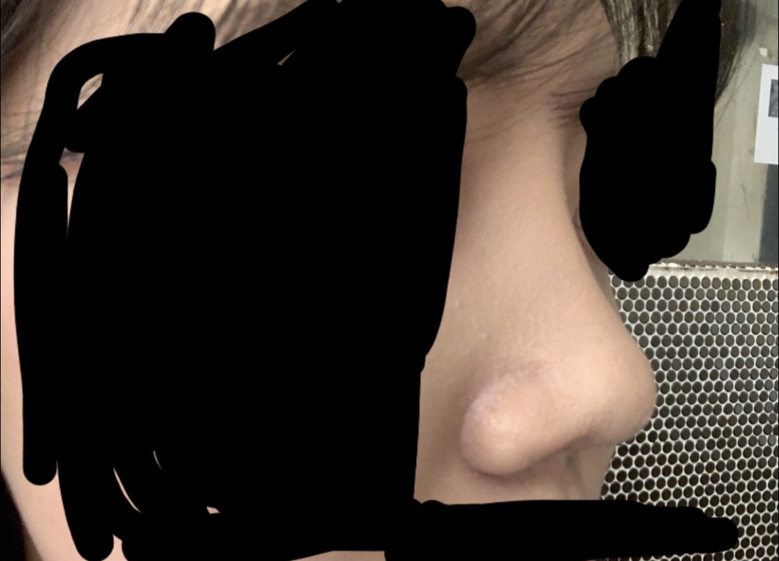 [Хамрын мэс засал] qwert2331 - Хамар