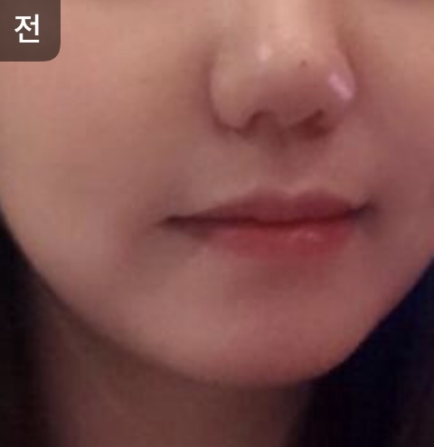 [Арьс] oy1004 - Лифтинг, Усан гялбааны тариа