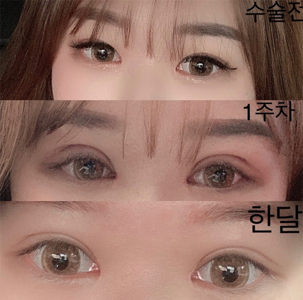 [Нүд] Росион - Дээд зовхины нээлт, Нүдний хэлбэр засах, Давтан мэс засал