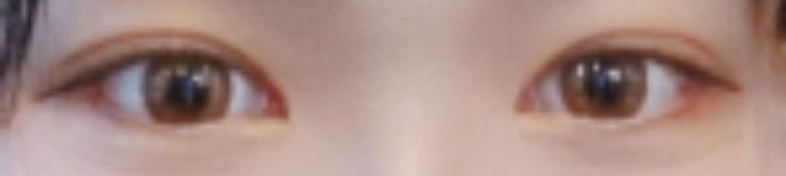 [Нүд] Зовхины мэс засал хийлгэсэн - Нүд