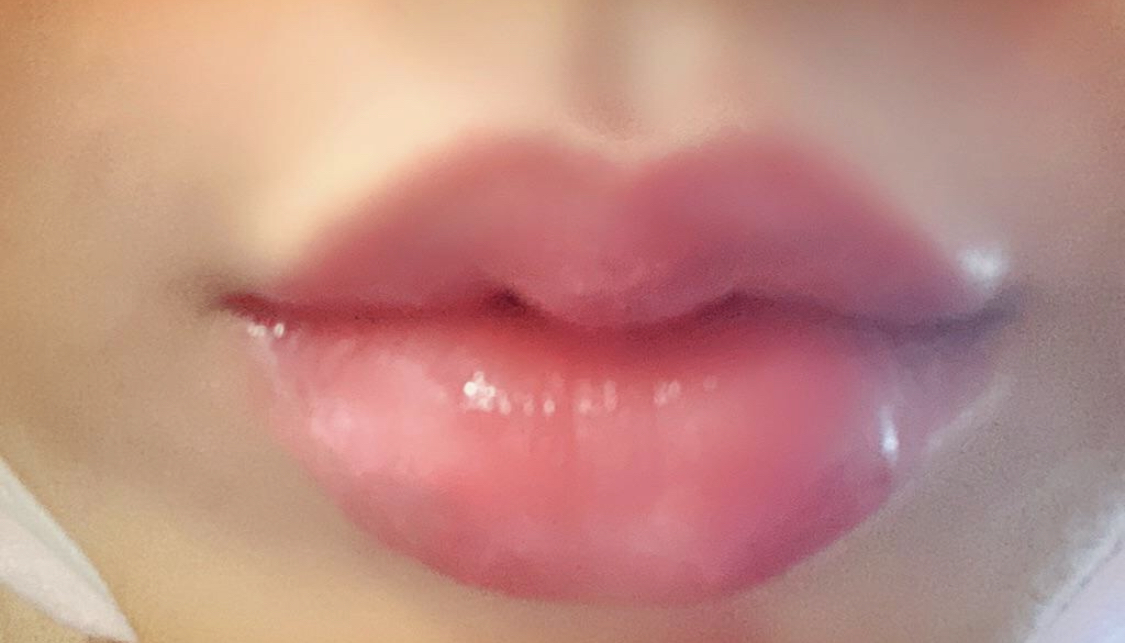 [Бяцхан] Жинхэнэ 2 - Уруулын филлер