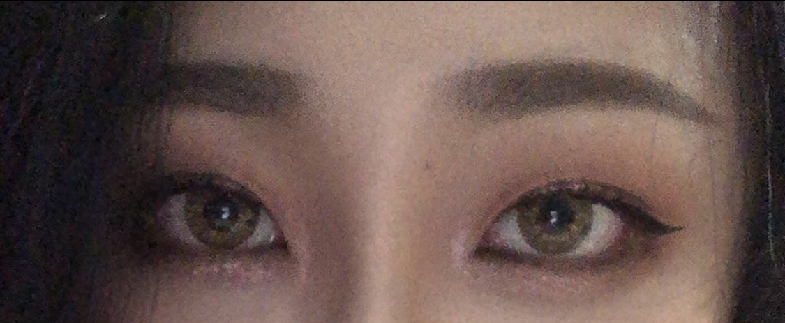 [Нүд] Хайхыйны - Доод зовхины тайралт, Арьс тайралт