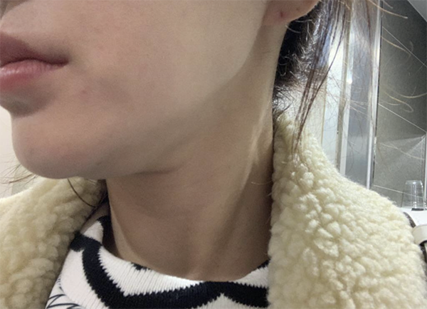 [Бяцхан] Рудольф ээж - Ботокс, нүүрний контур тариа