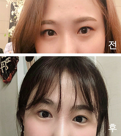 [Нүд] Кюүжинаа - Ар, доод зовхины тайралт