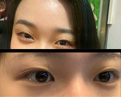 [Нүд] Жихе 1 - Булцуут, Нүдний хэлбэр засах